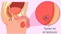 LOS TUMORES TESTICULARES