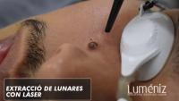 Los lunares y qué cuidado conllevan para la salud